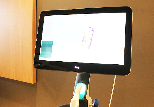 口腔内スキャナー「iTero」